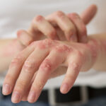 Aumento dei casi di morbillo in Italia, 269 tra gennaio e aprile