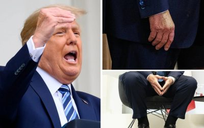 Gambe gonfie per Trump: è insufficienza venosa cronica