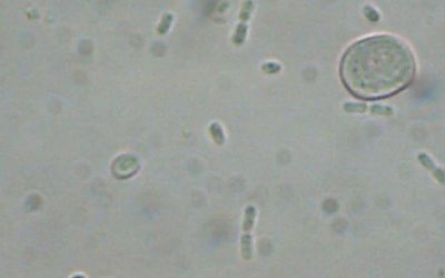 Vibrio vulnificus uccide 4 persone in Florida nel 2025