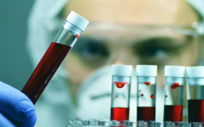 Identificati biomarcatori ematici per approccio più rapido e accessibile che migliori screening esistenti C'è un filo rosso, un legame tra il declino cognitivo autoriferito e alcuni biomarcatori ematici, che potrebbe aprire la strada a un semplice esame del sangue per diagnosticare la malattia di Alzheimer e le demenze correlate. A identificarlo un team di scienziati dell'University of California San Diego School of Medicine, autori di uno studio che si inserisce nel filone in pieno sviluppo di lavori finalizzati a rendere il più precoce possibile la diagnosi di questa patologia. I risultati di quest'ultima ricerca, condotta su adulti ispanici e latini, sono pubblicati sulla rivista 'Jama Network Open' e delineano un approccio che potrebbe essere "più rapido, meno invasivo e più conveniente" rispetto agli strumenti di screening esistenti, spiegano gli esperti. Con l'invecchiamento della popolazione e i numeri dei pazienti colpiti da Alzheimer in crescita, si tratta di un obiettivo su cui diversi gruppi stanno lavorando. "Abbiamo bisogno di metodi per identificare precocemente eventuali malattie neurodegenerative nei pazienti con sintomi cognitivi", sottolinea l'autore corrispondente dello studio Freddie Márquez, ricercatore post-dottorato del Dipartimento di Neuroscienze dell'ateneo californiano. Una promessa può essere rappresentata dai "biomarcatori basati sul sangue", che si profilano come "strumento più accessibile e scalabile per comprendere il declino cognitivo, in particolare nelle popolazioni che sono state scarsamente trattate con i metodi tradizionali", ragiona Márquez. Attualmente esiste un solo esame del sangue approvato dalla Food and Drug Administration (Fda) per aiutare a diagnosticare la malattia di Alzheimer. Sebbene questo test possa rilevare le proteine ​​nel sangue associate alla malattia che ruba i ricordi, è attualmente "molto costoso e disponibile solo in contesti di assistenza specialistica", illustrano gli esperti. Non è ancora chiaro se il sangue possa essere utilizzato in modo affidabile per la diagnosi precoce dell'Alzheimer su larga scala. Per rispondere a questa domanda, i ricercatori hanno utilizzato i dati di uno studio clinico - 'Study of Latinos-Investigation of Neurocognitive Aging' - che ha valutato la neurocognizione in un sottogruppo di partecipanti al più ampio e completo studio a lungo termine sulla salute e le patologie di ispanici e latinoamericani negli Stati Uniti (l'Hispanic Community Health Study/Study of Latinos). "Si ritiene che gli adulti ispanici e latini registreranno il maggiore aumento della prevalenza della malattia nei prossimi decenni", evidenzia l'autore senior Hector M. González, professore del Dipartimento di Neuroscienze della UC San Diego School of Medicine. "Ciò nonostante, sono ancora significativamente sottorappresentati nella ricerca sull'Alzheimer e sulla demenza, un aspetto che il nostro studio si proponeva di affrontare". I ricercatori hanno analizzato il sangue di 5.712 adulti di questo gruppo, età tra 50 e 86 anni, alla ricerca di proteine ​​presenti nel cervello di persone affette da Alzheimer, come ​​beta-amiloide e tau. Hanno anche valutato il declino cognitivo soggettivo dei partecipanti, cioè il declino percepito dalla persona stessa. Mettendo insieme questi elementi, gli scienziati hanno scoperto che livelli ematici più elevati di NfL (marcatore di danno alle cellule nervose) e Gfap (marcatore di infiammazione cerebrale) sono associati a un maggiore declino - autoriferito - del pensiero, della pianificazione e delle prestazioni cognitive complessive. Livelli ematici più elevati di NfL e proteina tau (ptau-181) sono stati associati anche a un maggiore declino - autoriferito - della memoria. Mentre i livelli ematici della proteina beta-amiloide (Aβ42/40), una proteina notoriamente associata nel cervello al morbo di Alzheimer, non hanno mostrato associazione con il declino cognitivo soggettivo. Anche nelle persone cognitivamente sane sono rimaste valide le associazioni tra NfL e cali autoriferiti delle prestazioni cognitive, il che - valutano gli esperti - suggerisce che NfL potrebbe rilevare cambiamenti precoci nella cognizione. Oltre a fornire evidenze del fatto che i biomarcatori del sangue possono essere utilizzati per rilevare precocemente l'Alzheimer e le demenze, i ricercatori sottolineano anche che un punto di forza dello studio è la sua popolazione eterogenea. "Includendo partecipanti provenienti da comunità sottorappresentate, siamo in grado di comprendere meglio come i determinanti sociali della salute e le comorbilità possano influenzare i percorsi cognitivi e il rischio di demenza", aggiunge Márquez. "Questo rende i nostri risultati particolarmente rilevanti per i contesti del mondo reale". Saranno ora necessarie ulteriori ricerche - tengono a puntualizzare gli autori - prima che questo approccio trovi ampia diffusione nella pratica clinica e, anche quando ciò accadrà, il test sarà comunque uno degli strumenti nell'arsenale diagnostico del medico. "E' importante sottolineare che c'è ancora molto che non sappiamo sull'utilità dei biomarcatori ematici per la diagnosi dell'Alzheimer", conclude Márquez. "Questi test hanno un potenziale enorme, ma dovrebbero integrare gli approcci esistenti, non sostituirli". (Redazione/Adnkronos) ISSN 2499 - 3492 09-Sep-2025 18:31 TAG: Alzheimer, diagnosi precoce, esame del sangue, biomarcatori ematici