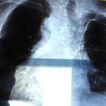 Polmonite in Italia, 150mila ricoveri e 9mila morti l’anno