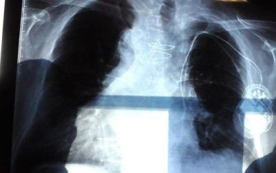 Polmonite in Italia, 150mila ricoveri e 9mila morti l’anno